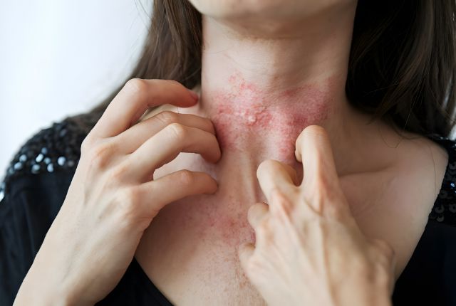 アトピー性皮膚炎とは