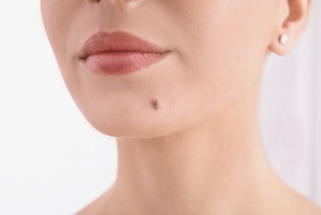 尋常性疣贅とは