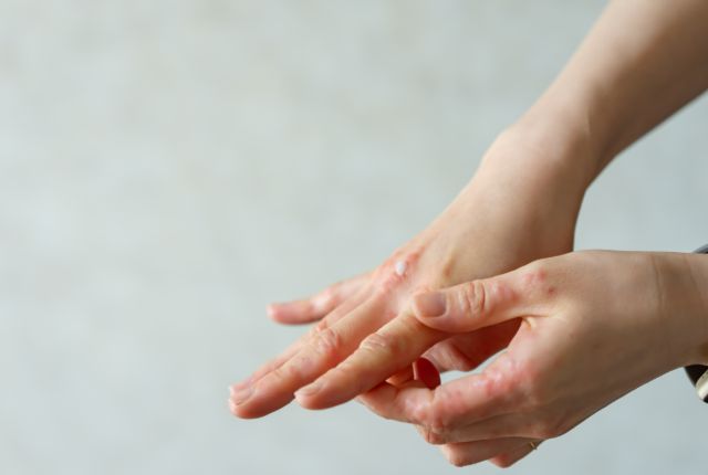 手湿疹（手荒れ）とは